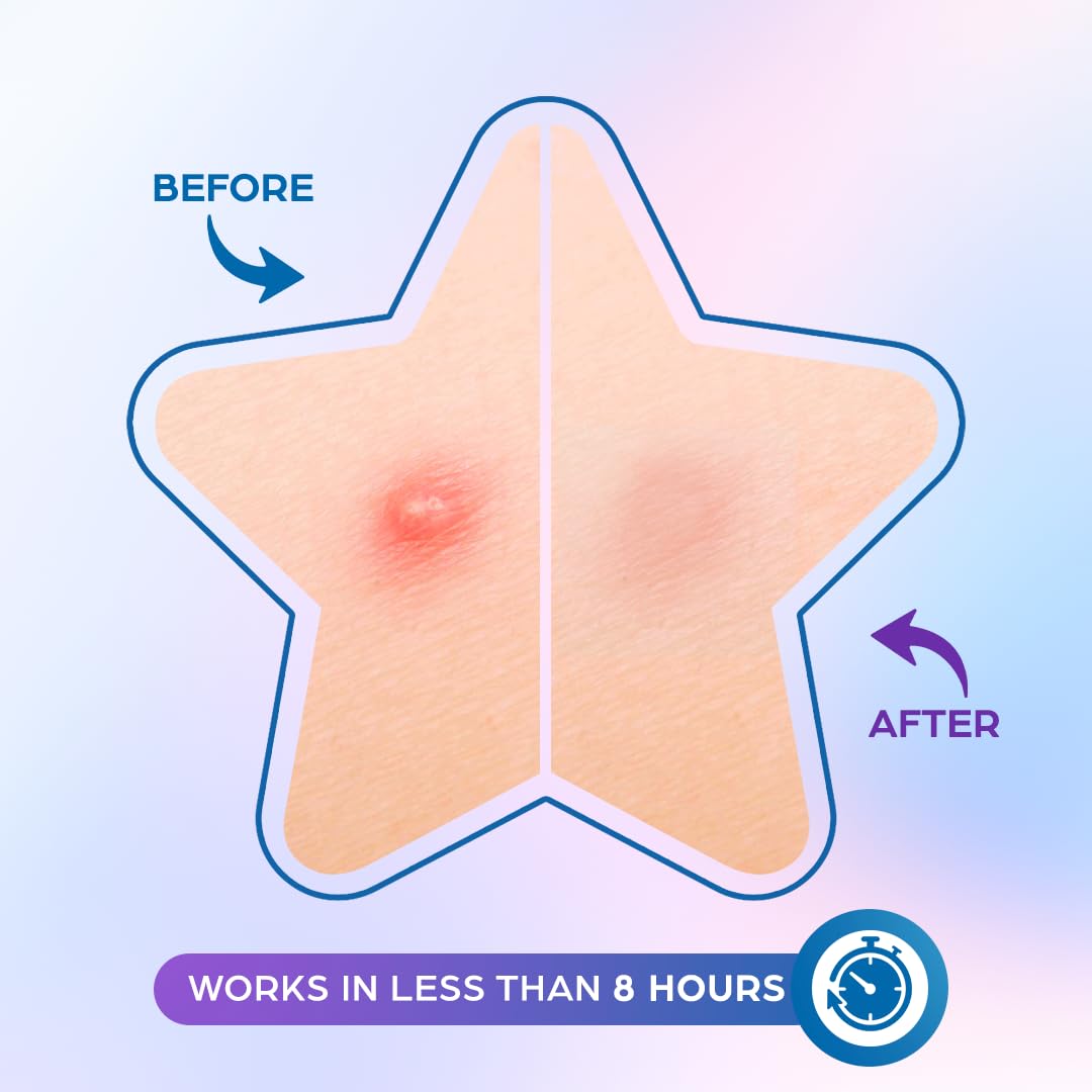 KEYCONCEPTS Star Pimple Patches for Face (100 Pack, Cute), Pimple Patches Stars - Hydrocolloid Star Patches for Pimples with Tea Tree Oil - Star Stickers for Face - Pimple Stickers - Star Acne Patch